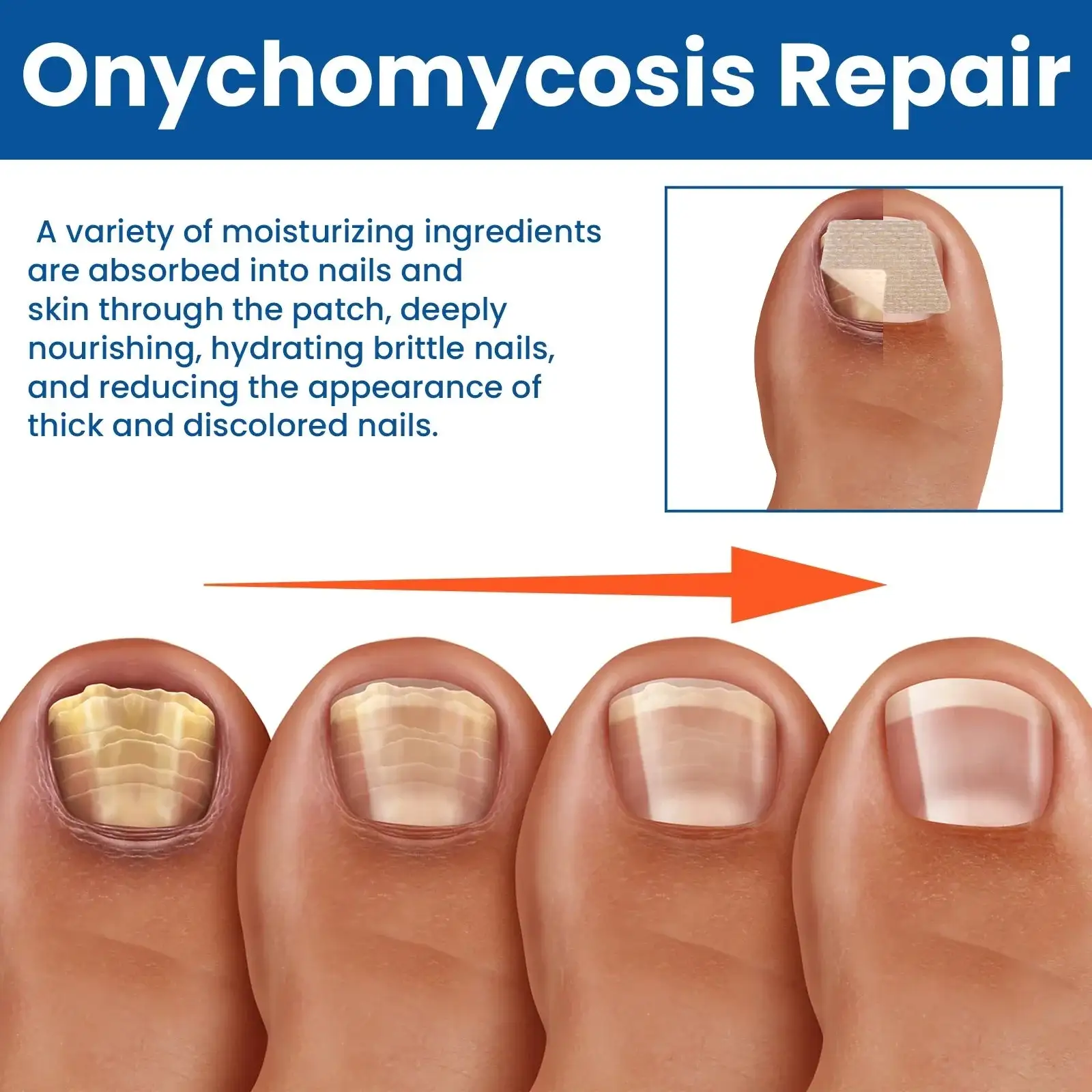 Reparaturpflaster gegen Nagelpilz – Bild 4
